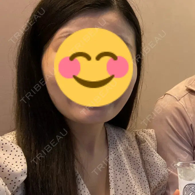 糸リフト / 脂肪吸引（顔） / ボトックス（エラ・小顔） RIVER CLINIC（リバークリニック） DAY 13 メイン用