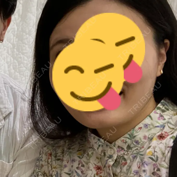 糸リフト / 脂肪吸引（顔） / ボトックス（エラ・小顔） RIVER CLINIC（リバークリニック） AFTER メイン用