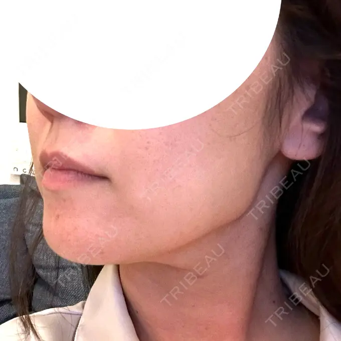 ハイフ（顔） 東京美容外科 福岡院 AFTER メイン用