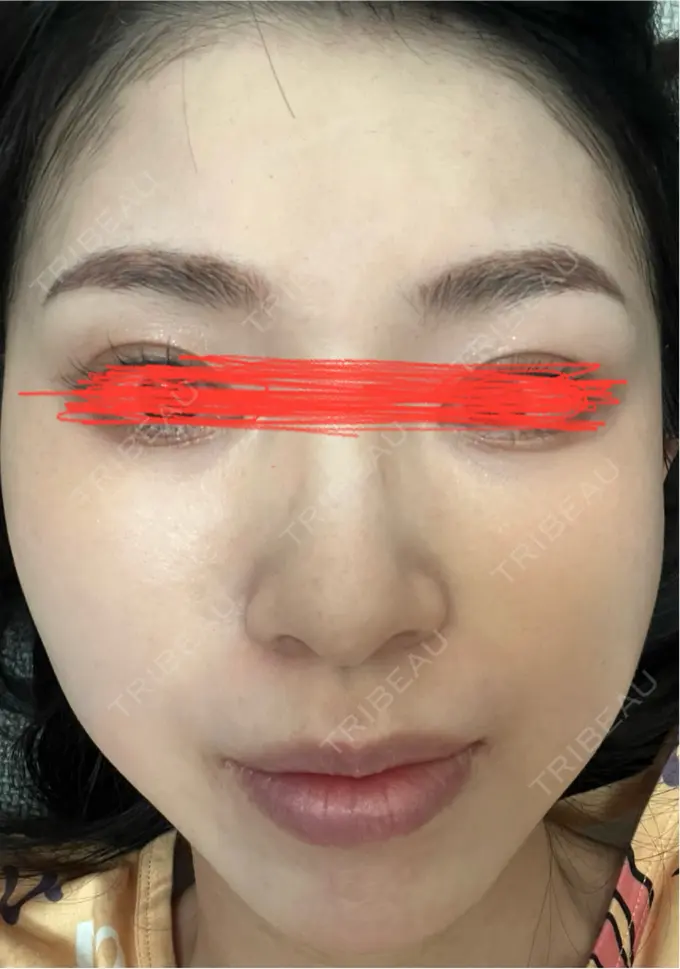 イオン導入 ルラ美容クリニック 名古屋本院 DAY 5 メイン用