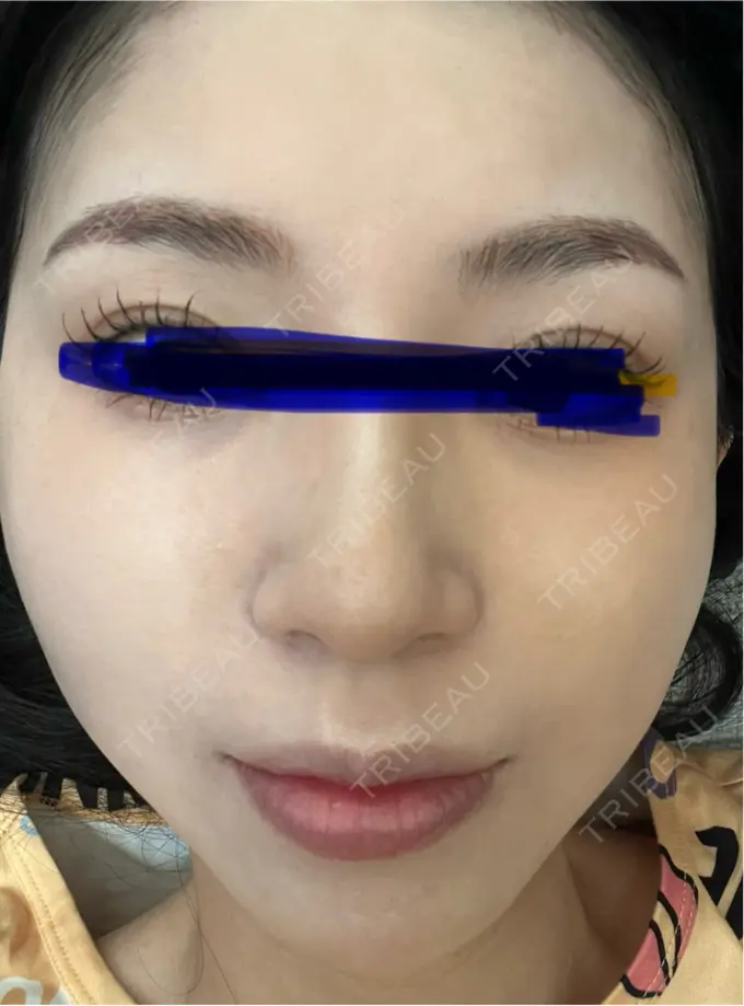 イオン導入 ルラ美容クリニック 名古屋本院 DAY 6 メイン用