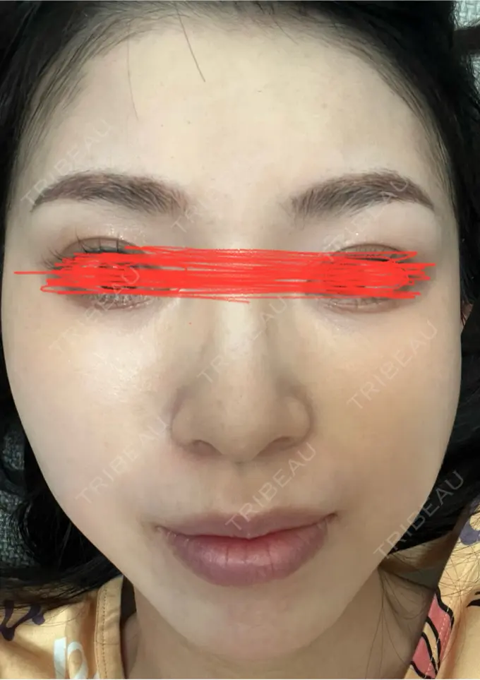 ルメッカ ルラ美容クリニック 名古屋本院 DAY 5 メイン用