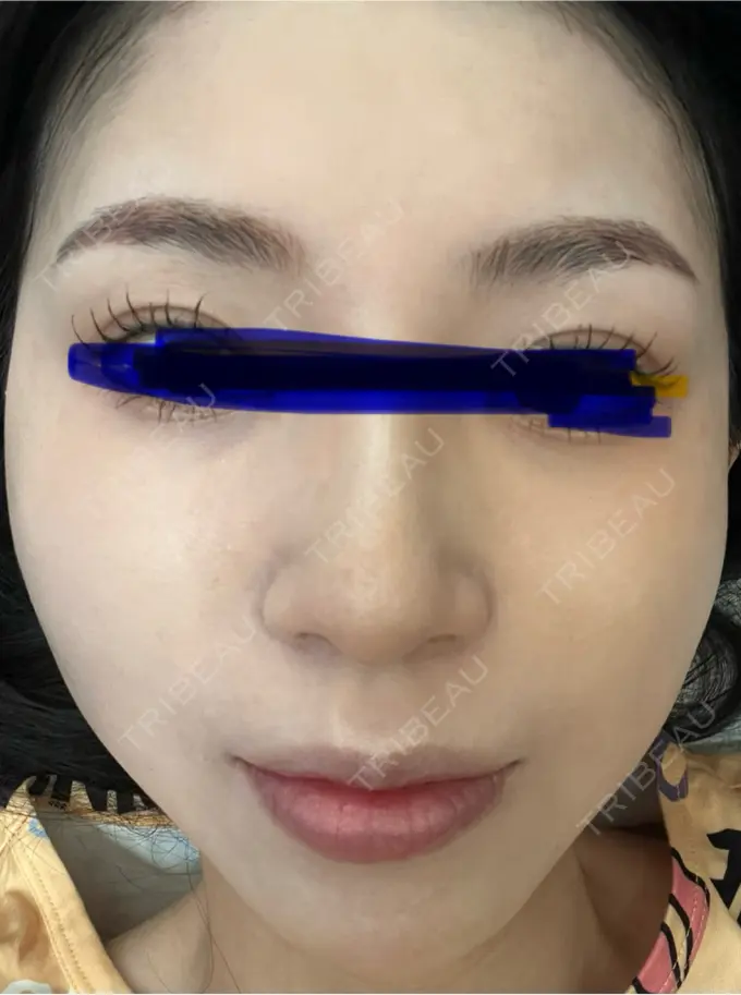 ルメッカ ルラ美容クリニック 名古屋本院 DAY 6 メイン用