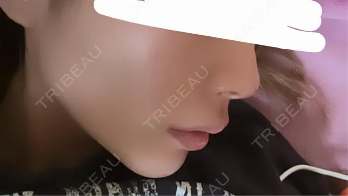 ヒアルロン酸注入（鼻） / ボトックス（あご） / ヒアルロン酸注入（唇） / ヒアルロン酸注入（鼻翼基部） ルラ美容クリニック 池袋院 AFTER メイン用