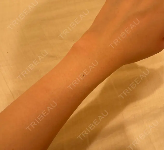 医療脱毛（全身） ジュエルクリニック 恵比寿院 DAY 3 メイン用