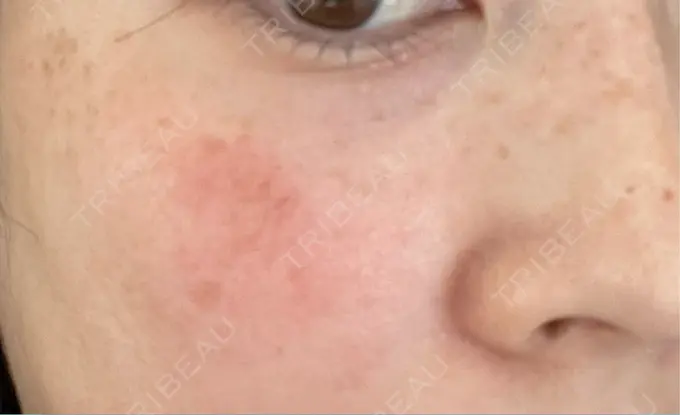 シミ取りレーザー Mavie Beauty Clinic （マヴィービューティークリニック） AFTER メイン用