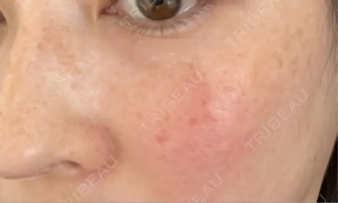 シミ取りレーザー Mavie Beauty Clinic （マヴィービューティークリニック） DAY 14 メイン用