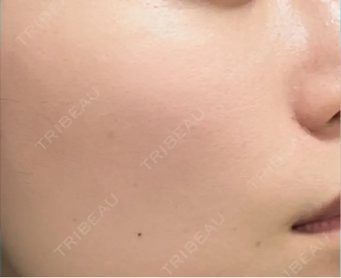 ピーリング（ハリ・ツヤ） 新宿美容外科クリニック 新宿院 AFTER メイン用