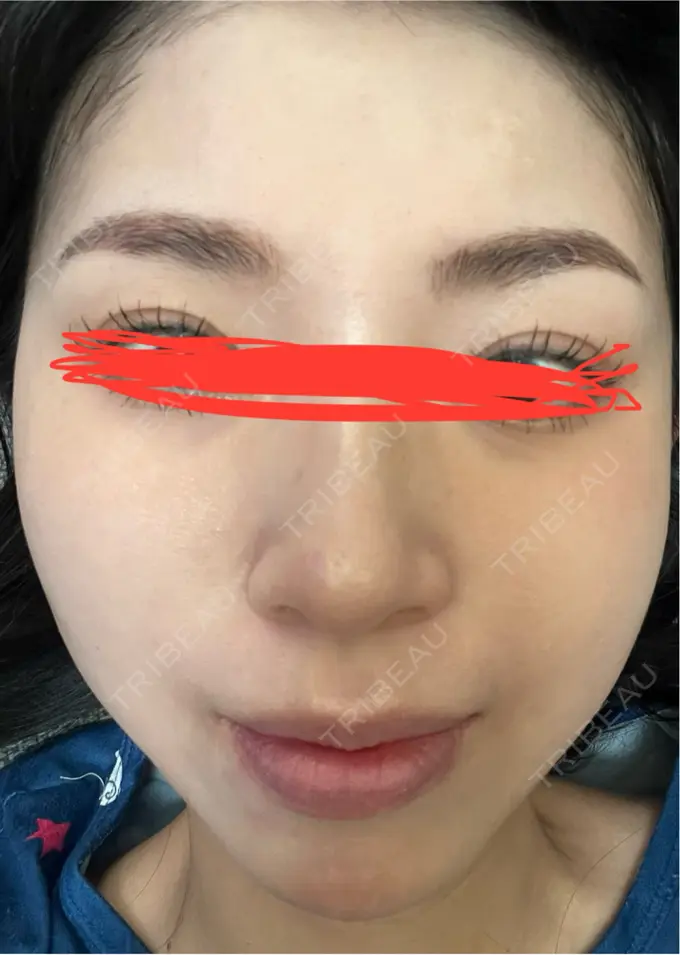 イオン導入 ルラ美容クリニック 名古屋本院 DAY 7 メイン用