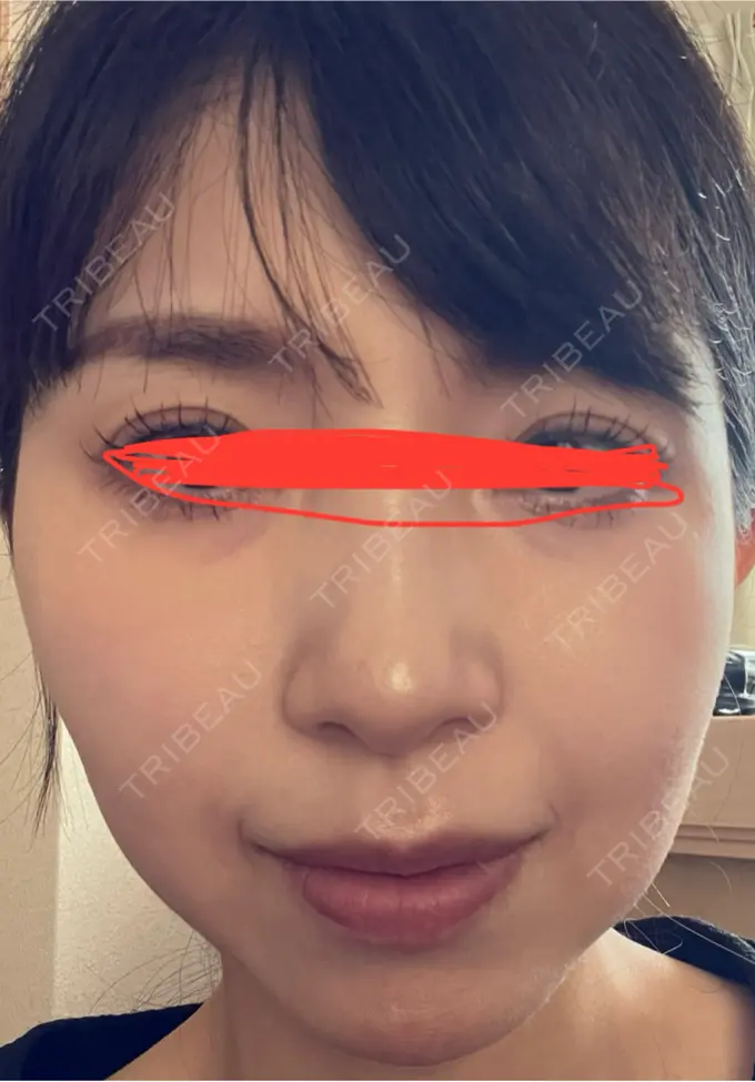 イオン導入 ルラ美容クリニック 名古屋本院 DAY 8 メイン用