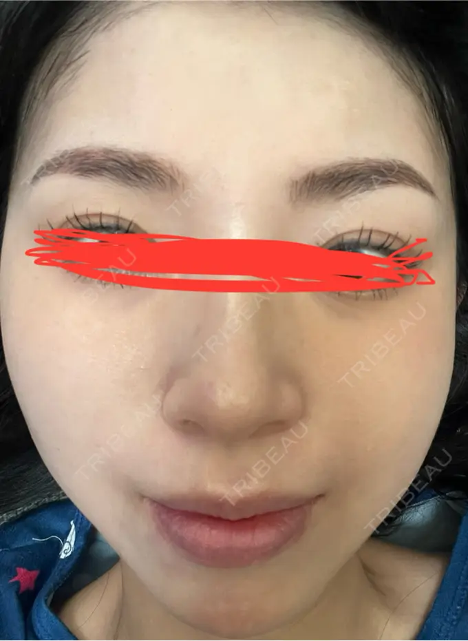 ルメッカ ルラ美容クリニック 名古屋本院 DAY 7 メイン用