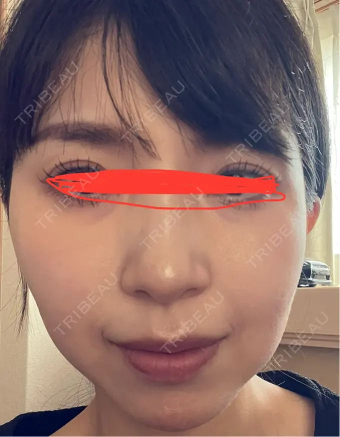 ルメッカ ルラ美容クリニック 名古屋本院 DAY 8 メイン用