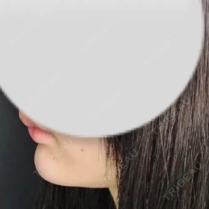 ボトックス（あご） / ヒアルロン酸注入（あご） Tokyo Tensei Clinic 新宿院 AFTER メイン用