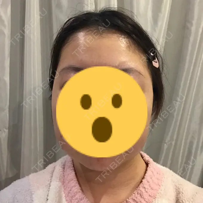 バッカルファット除去 / 脂肪吸引（顔） THE PLAN（ザ・プラン）美容整形外科・皮膚科 DAY 20 メイン用