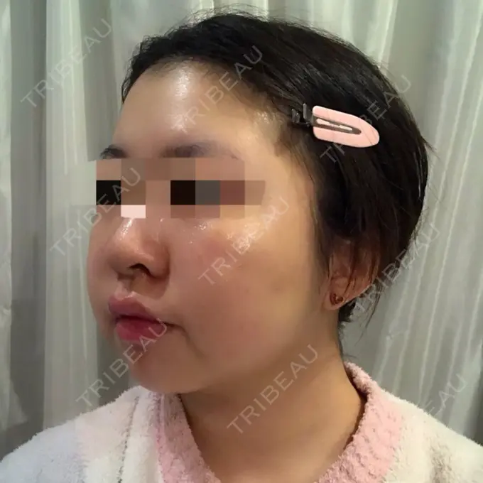 バッカルファット除去 / 脂肪吸引（顔） THE PLAN（ザ・プラン）美容整形外科・皮膚科 DAY 20 メイン用