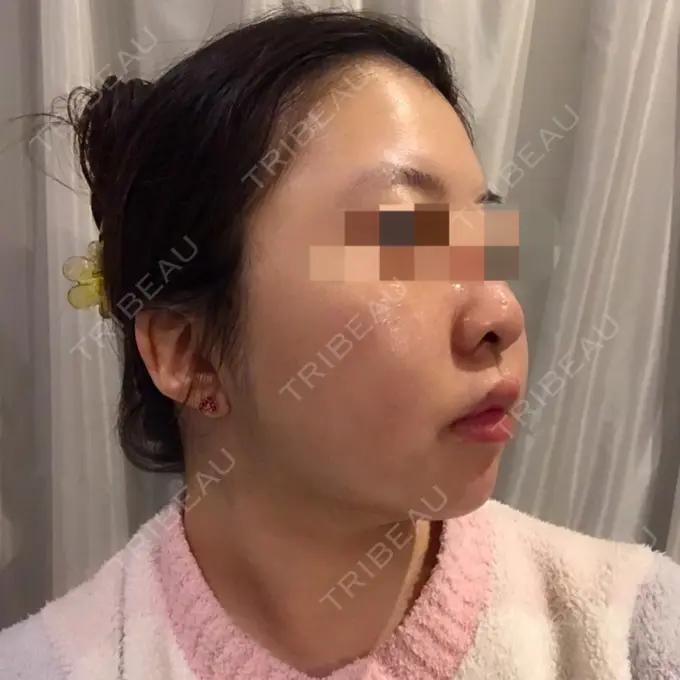 バッカルファット除去 / 脂肪吸引（顔） THE PLAN（ザ・プラン）美容整形外科・皮膚科 DAY 20 メイン用