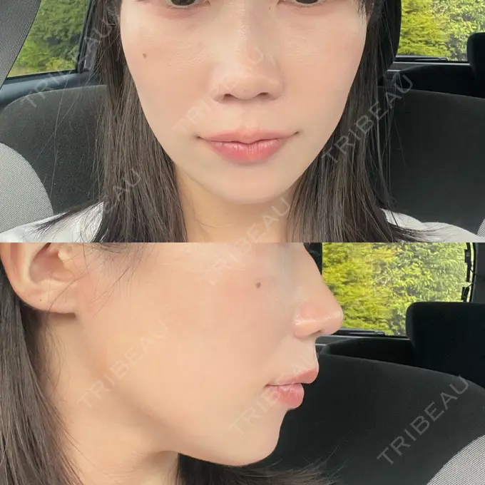 ボトックス（あご） / ヒアルロン酸注入（頬） / ヒアルロン酸注入（鼻翼基部） ルラ美容クリニック 池袋院 DAY 2 メイン用