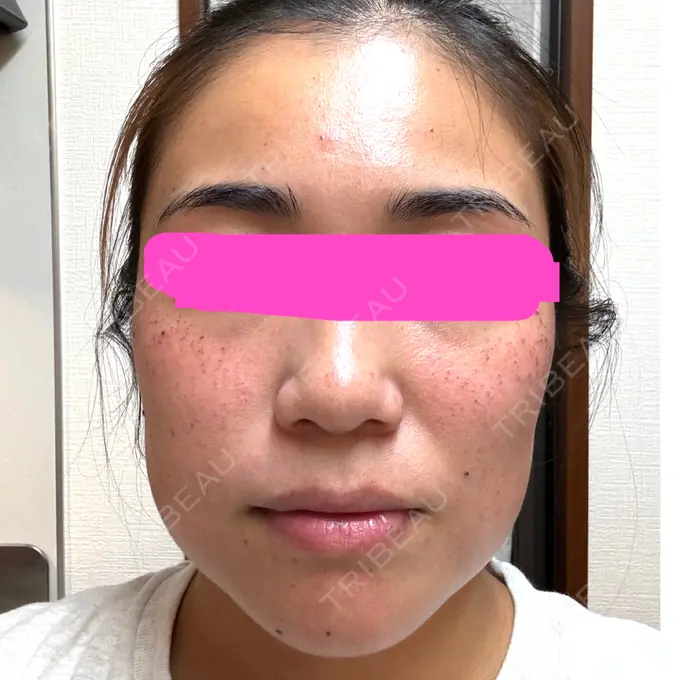 ルメッカ 東京美容外科 京都河原町院 DAY 0 メイン用