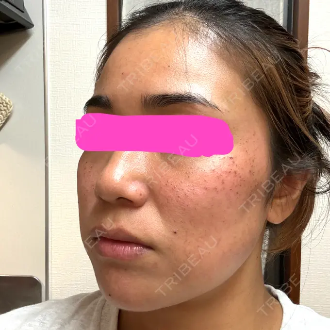 ルメッカ 東京美容外科 京都河原町院 DAY 0 メイン用