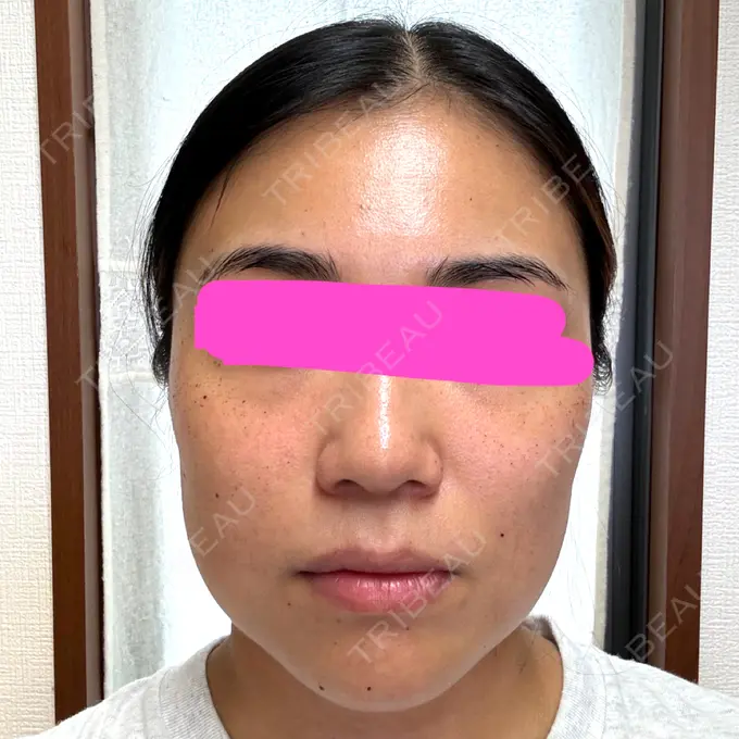 ルメッカ 東京美容外科 京都河原町院 AFTER メイン用