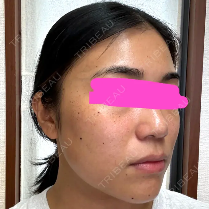 ルメッカ 東京美容外科 京都河原町院 DAY 2 メイン用