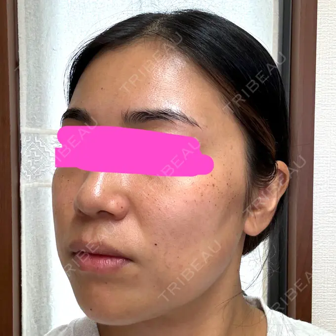 ルメッカ 東京美容外科 京都河原町院 DAY 2 メイン用