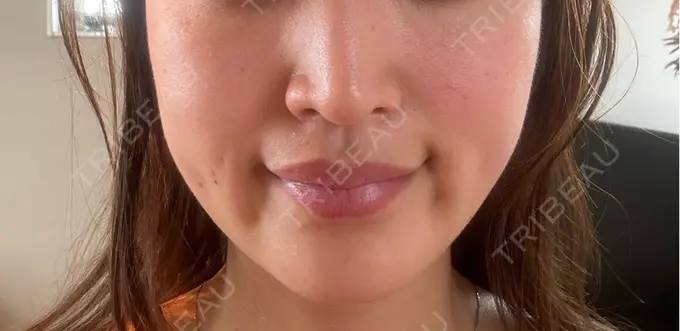 糸リフト / ボトックス（エラ・小顔） VSラインクリニック-江南店 AFTER メイン用