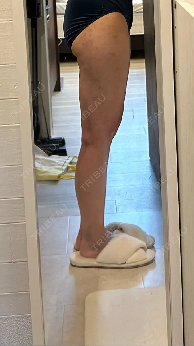 脂肪吸引（脚） / 脂肪吸引（お尻） Mods Clinic（モッズクリニック） 名古屋院 DAY 100 メイン用