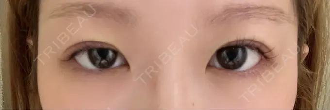 二重埋没 水の森美容クリニック 東京銀座院 DAY 0 メイン用