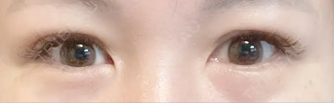 二重埋没 / 上まぶたの脂肪取り 恵聖会クリニック 梅田院 DAY 12 メイン用