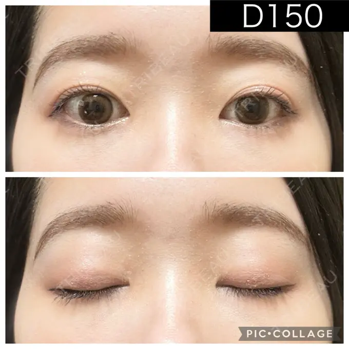 二重埋没 湘南美容クリニック 町田院 DAY 150 メイン用