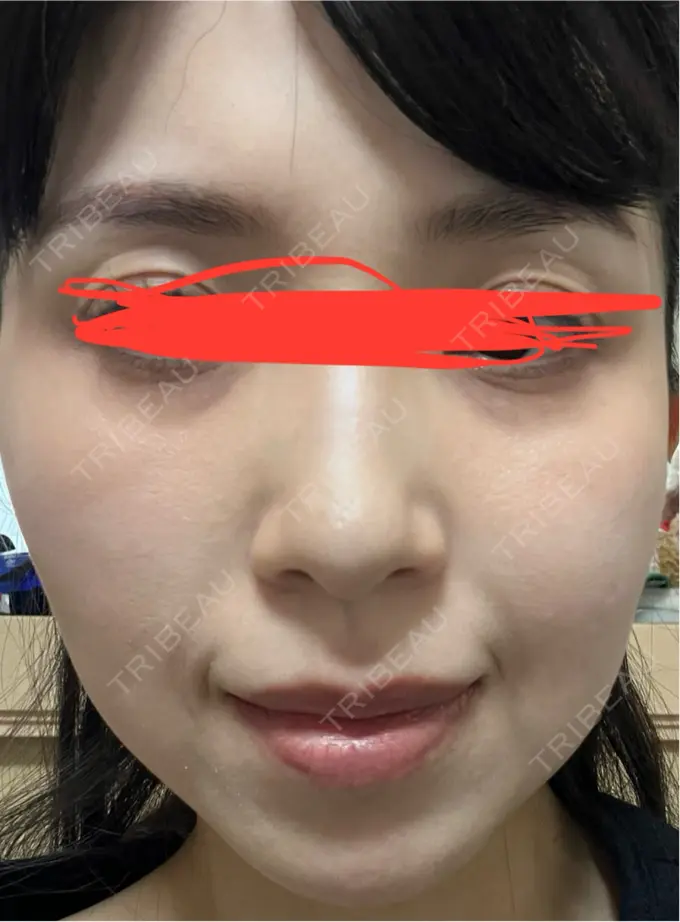 イオン導入 ルラ美容クリニック 名古屋本院 DAY 9 メイン用