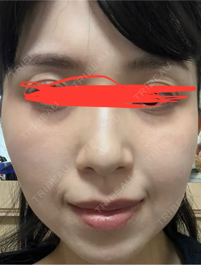 ルメッカ ルラ美容クリニック 名古屋本院 DAY 9 メイン用