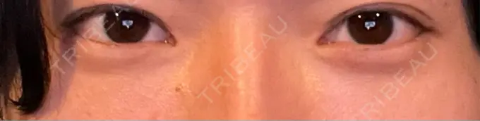 クマ治療 ROOTS Clinic DAY 0 メイン用