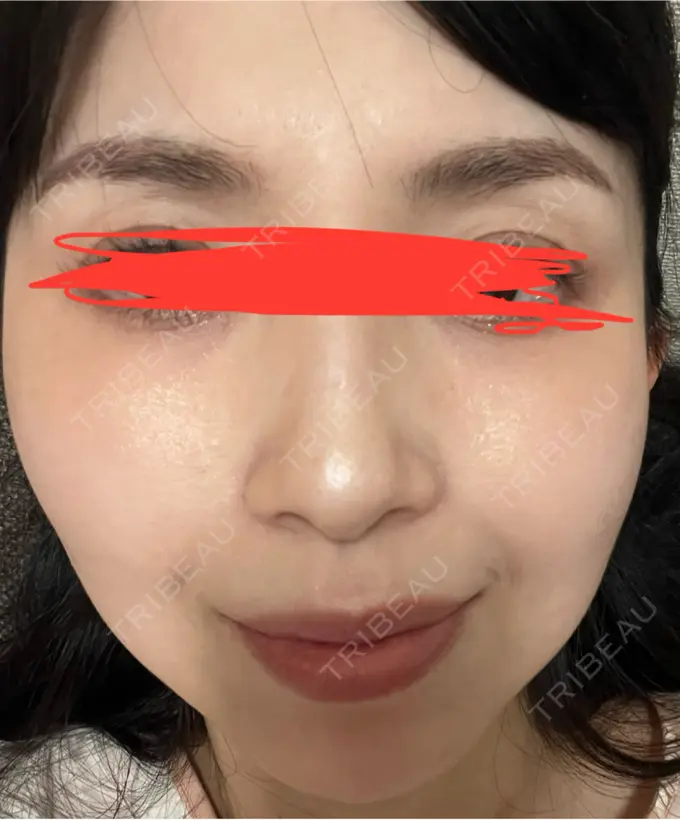 イオン導入 ルラ美容クリニック 名古屋本院 DAY 10 メイン用