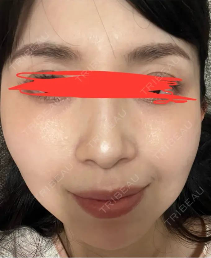 ルメッカ ルラ美容クリニック 名古屋本院 DAY 10 メイン用