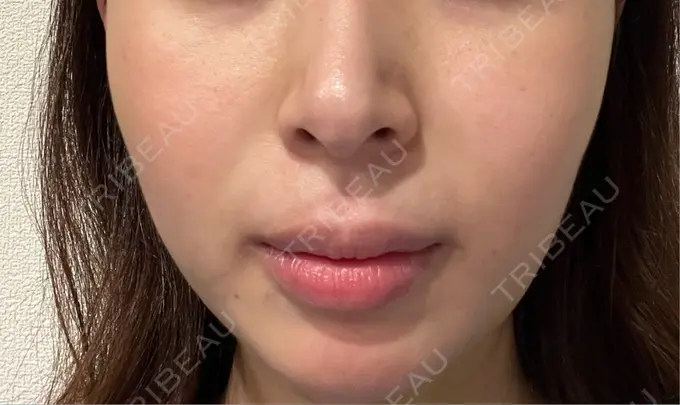 肌ヒアルロン酸注入（たるみ・シワ改善） / 水光注射（ハリ・美肌） シェリークリニック 福岡院 DAY 6 メイン用