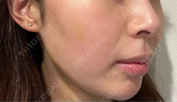 肌ヒアルロン酸注入（たるみ・シワ改善） / 水光注射（ハリ・美肌） シェリークリニック 福岡院 DAY 6 メイン用