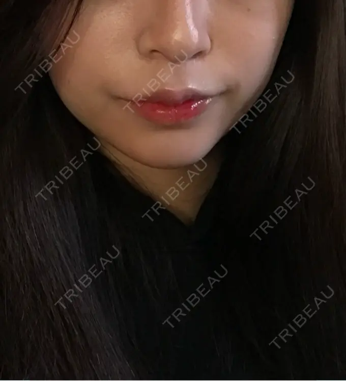 ヒアルロン酸注入（あご） 品川美容外科 名古屋院 AFTER メイン用