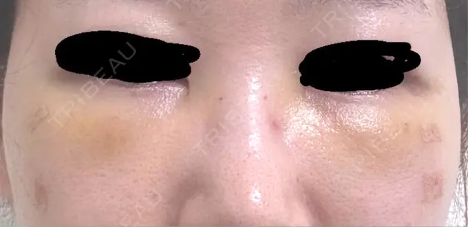 クマ治療 / 下まぶたの脂肪取り / 脂肪注入（目の下） 吉井クリニック DAY 3 メイン用