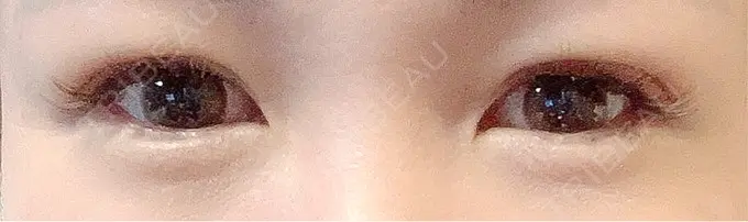 二重埋没 / 上まぶたの脂肪取り 恵聖会クリニック 梅田院 DAY 13 メイン用