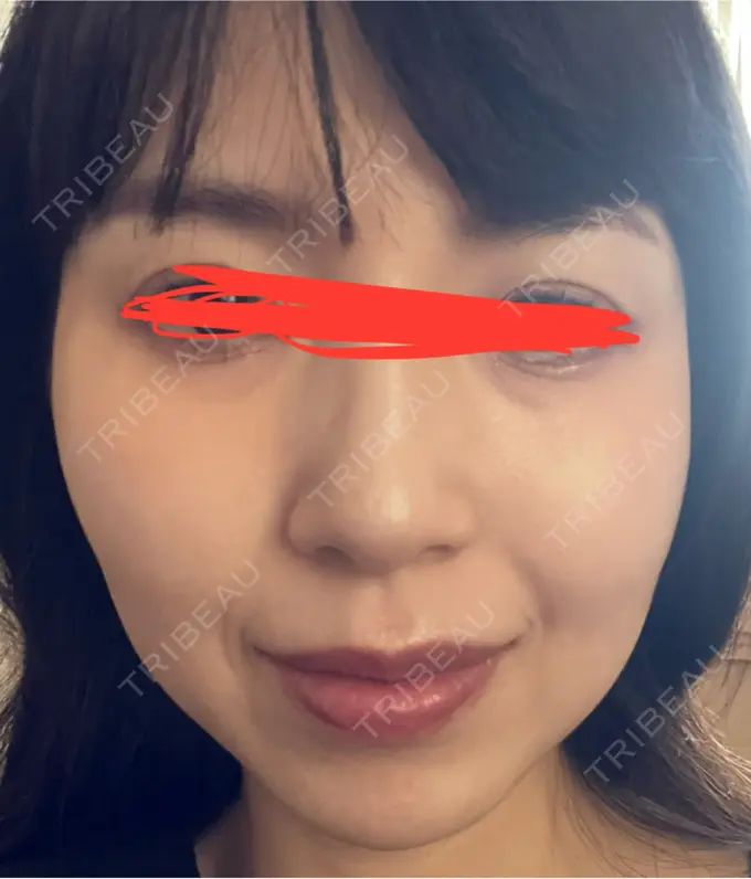 イオン導入 ルラ美容クリニック 名古屋本院 AFTER メイン用