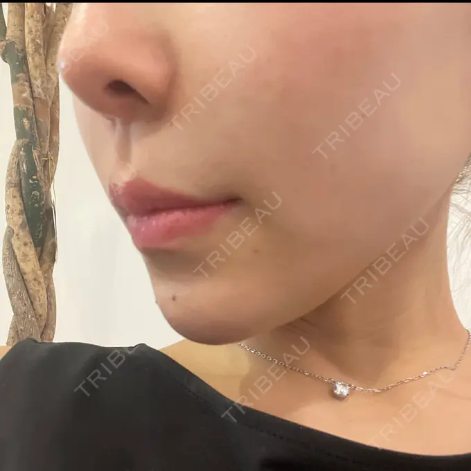 ヒアルロン酸注入（あご） / ボトックス（眉間） / ボトックス（目尻） 湘南美容クリニック 立川院 AFTER メイン用