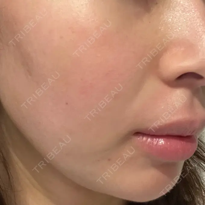 肌ヒアルロン酸注入（たるみ・シワ改善） / 水光注射（ハリ・美肌） シェリークリニック 福岡院 DAY 7 メイン用