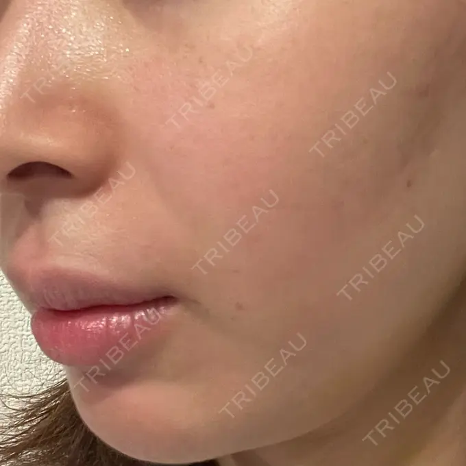 肌ヒアルロン酸注入（たるみ・シワ改善） / 水光注射（ハリ・美肌） シェリークリニック 福岡院 DAY 7 メイン用