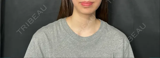 ボトックス（エラ・小顔） / ボトックス（肩） THE FIRST CLINIC 多摩センター院 AFTER メイン用