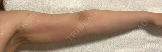 脂肪吸引（二の腕） ルーチェクリニック 銀座院 DAY 29 メイン用