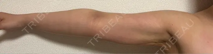 脂肪吸引（二の腕） ルーチェクリニック 銀座院 DAY 29 メイン用