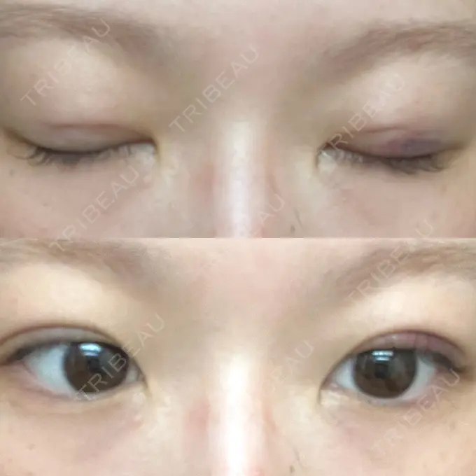 二重埋没 水の森美容クリニック 東京銀座院 DAY 1 メイン用