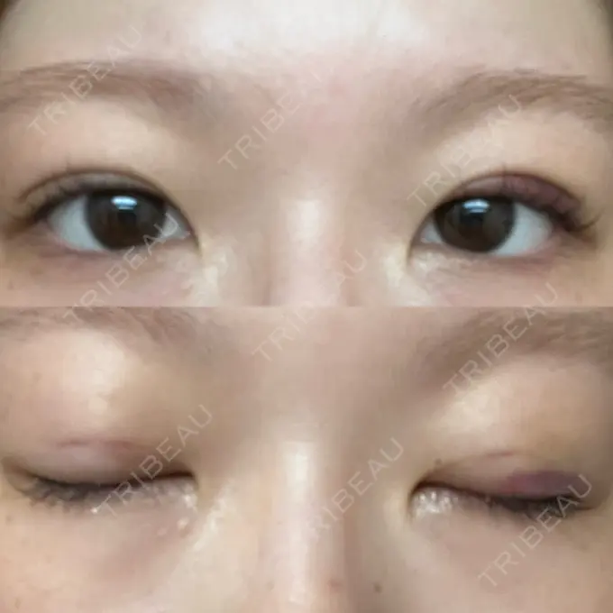 二重埋没 水の森美容クリニック 東京銀座院 DAY 2 メイン用